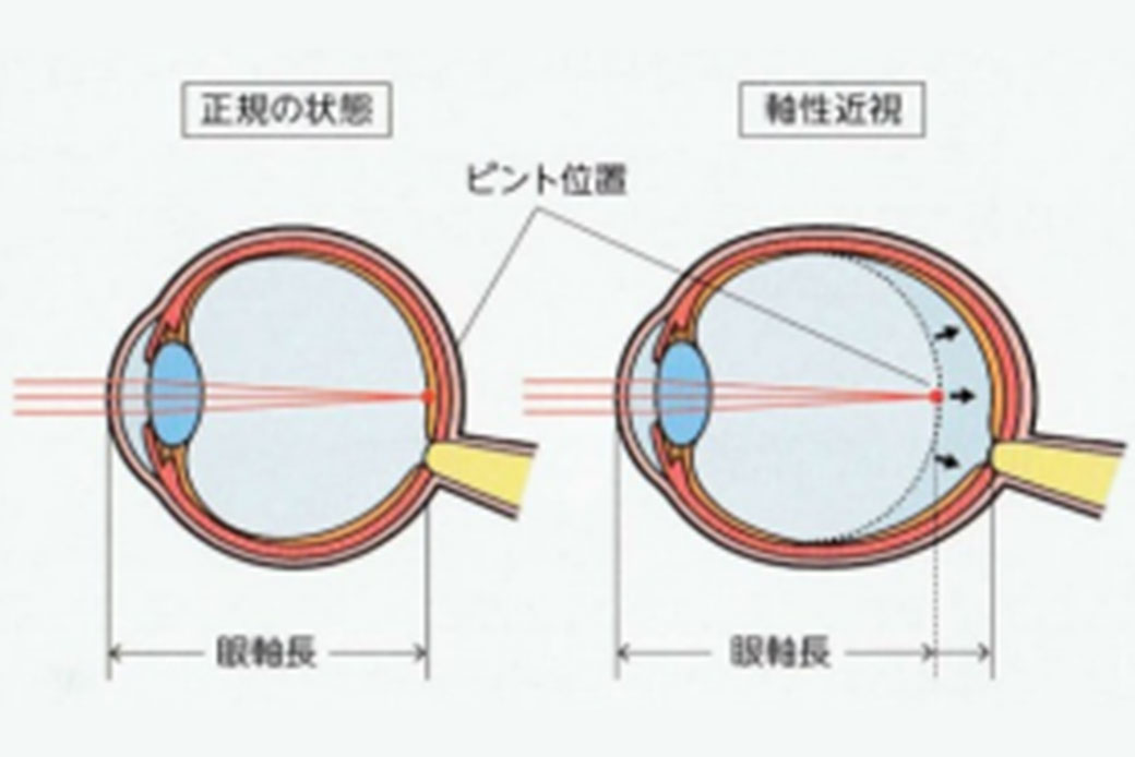 近視の進行を抑制することが大切な理由
