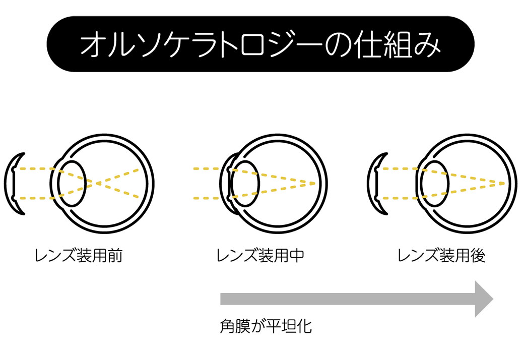 オルソケラトロジーの原理