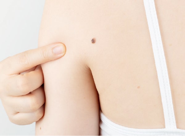 ほくろ